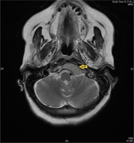 Figure 1 Case 1: Axial view magnetic resonance imaging brain showing mass involving the left side of the clivus and left occipital condyle. The yellow arrow shows the mass involving the left side of the clivus and occipital condyle.