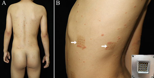 Figure 1 (A) Multiple scaly papules and plaques were scattered on the trunk. (B) Several scaly erythematosus papules were seen on the laser-treated hypopigmented areas (white arrows). Insert depicts the shape of laser machine.