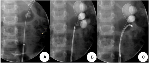 Figure 1 Demonstration of retrograde intra-renal surgery (RIRS) procedure steps in one of the cases of a child with a 2 cm renal stone. (A) insertion of ureteral access sheath (UAS). (B, C) insertion of the flexible ureteroscope accessing the lower pole.