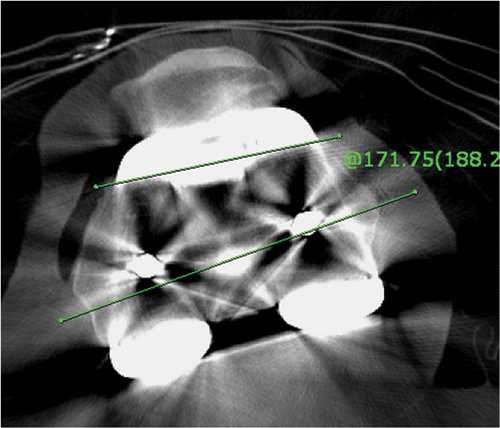 Figure 2. Rotational alignment of the femoral component was measured postoperatively using a transverse section of the CT scan.