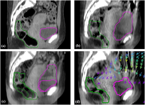 Figure 1. (a) Planning CT scan, (b) CBCT scan for same patient, (c) a 50–50 blend of (a) and (b) from rigid registration, (d) CBCT (b) deformed to match planning CT (a) with deformed OAR contours and arrows to indicate direction of movement.