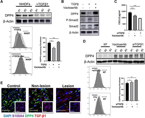 Figure 4 TGF-β induced CXCL12 accumulation through inhibition of DPP4 expression. (A) Western blot and flow cytometry analyses of DPP4 in NHDFs (n=3) after TGF-β1 treatment (10ng/mL). (B) The phosphorylation of smad2 in NHDFs after TGF-β treatment (10ng/mL) with or without vactosertib (500nM) was detected by Western blot. (C) ELISA analyses of DPP4 in KFs (n=3) after TGF-β1 treatment with or without vactosertib (500nM). (D) Western blot and flow cytometry analyses of DPP4 in KFs (n=3) after vactosertib (500nM) or siTGF-β1 treatment. (E) Immunofluorescence analysis of DPP4 and TGF-β1 expression in keloid tissue (n=12). Immunofluorescence sections prepared from the keloid tissue specimens. Fibroblasts were stained with anti-S100A4 antibody and are shown in the small window. Bars=50μm. ns= P>0.05, *P < 0.05, **P < 0.01, ***P < 0.001.