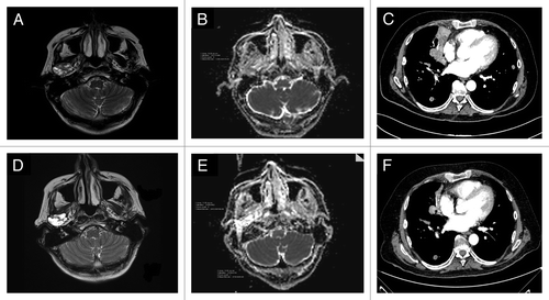Figure 1. Case 1: MRI performed before starting abiraterone (A); MRI done two months later, showed the evolution of the solid tumor lesion into a liquid mass (D). The DW-MRI images (B and E) demonstrated a different ADC maps, confirming the activity of the drug: the region of interest (ROI) corresponding to the tumor had a mean/standard deviation ADC value of 1200/178 in May 2012 (B) while in (E) (July 2012), the mean ADC/standard deviation value was 2410/166. Case 2: CT scan performed on March 2012 (baseline) (C) and on May 2012 (F); this latter showed a regression of the right paracardiac mass and the disappearance of a solid lesion in the lower left lobe.