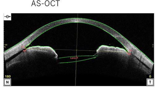 Figure 4 Patient 2’s AS-OCT results at 19 days after SF6 gas tamponade treatment. The ciliary detachment had improved, but the ciliary body did not attach.