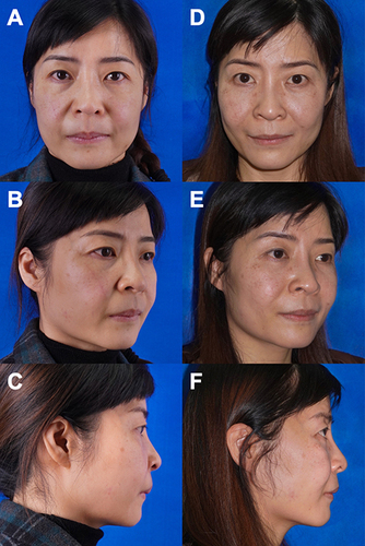 Figure 15 Preoperative (A–C) and 3 months postoperative (D–F) photographs of a 48-year-old female patient showing increased malar volume, elevated malar position, and decreased jowl volume.