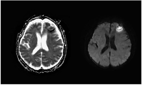Figure 5 DWI: Patchy diffusion restricted lesions with high signal in the left frontal lobe, the corresponding ADC diagram shows uneven low signal changes.