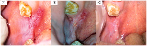 Figure 10. Patient suffering oral erythoplakia (A) before treatment, (B) after 3 weeks and (C) after 6 weeks (treated with CurSLN-gel).