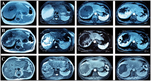 Figure 2. A 67-year-old female with a giant hepatic hemangioma of 13 cm in diameter. (A) Preoperative MRI (size: 13 cm × 9 cm). (B) MRI after the first ablation (size: 8 cm × 7 cm). (C) MRI after the second ablation (size: 10.8 cm × 7.8 cm).