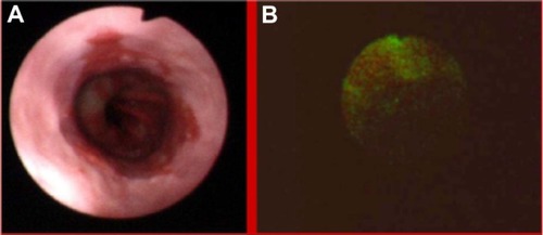 Figure 1 Low grade dysplasias in Barrett’s esophagus in white light endoscopy (A) and autofluorescence (B) imaging.