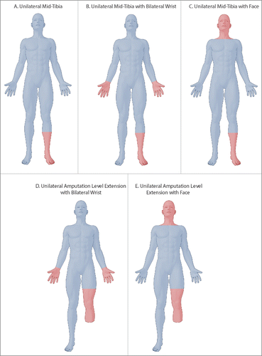 Figure 3. Illustrations of proposed next lower extremity allotransplantation recipient: (A) unilateral mid-tibia, (B) unilateral mid-tibia with bilateral wrist, (C) unilateral mid-tibia with face, (D) unilateral amputation level extension with bilateral wrist, and (E) unilateral amputation level extension with face. Note distal level of proposed hand transplants in B and D. Blue highlights recipient's preoperative status and red highlights allotransplants.