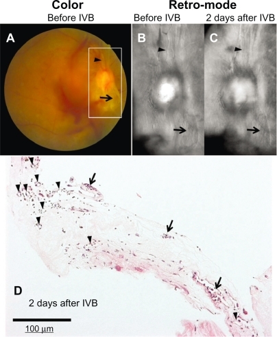 Figure 2 Case 2. A 39-year-old man with severe fibrovascular proliferation around the optic nerve head (A). Neovascular vessels in the fibrovascular membrane were clearly observed in the retro-mode image (B). Two days after intravitreal bevacizumab (IVB), most of the new vessels had regressed. However, in the retro-mode imaging, neovascular vessel structures were still observed (C). Arrows and arrowheads indicate same neovascular vessels in the different images. Staining of the neovascular tissue from this case with hematoxylin-eosin disclosed that many neovascular capillaries were still present (arrowheads), but that only large vessels contained red blood cells (arrows) (D).