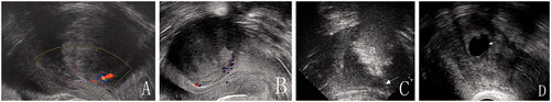 Figure 1. (A) Transvaginal sonographic image before treatment. (B) Three months after mifepristone treatment. The fibroid volume reduction is 45%; (C) RFA procedure (a = hyperechogenic zone arrow = electrode); (D) Twelve months after the procedure. (Arrow = the secondary cystic changes); The fibroid volume reduction is 85%.