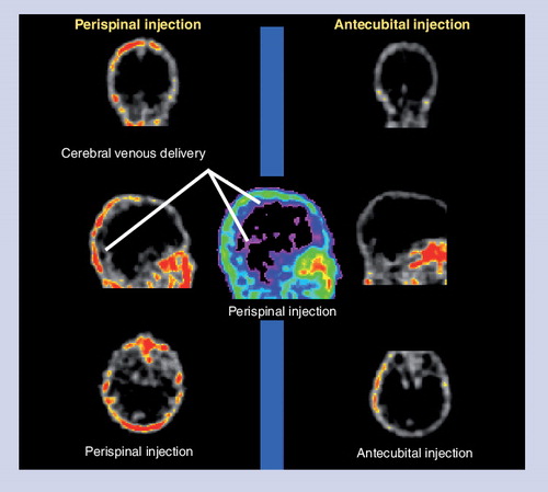 Figure 2. Single proton-emission computerized tomography imaging results following perispinal and antecubital injection of 99mTc-DTPA in a human.Delivery of radiolabeled DTPA into the cerebral venous system following perispinal administration is demonstrated. The imaging pattern suggests enhanced cerebral venous delivery following perispinal administration compared with antecubital administration. The three images on the left and the central image followed perispinal injection and inversion. The three images on the right followed antecubital injection and inversion.DPTA: Diethylenetriaminepentaacetic acid; Tc: Technicium.