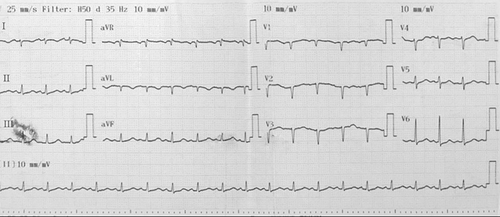 Figure 1 Admission electrocardiogram showed sinus tachycardia, poorly progressive R wave from V1 to V3 leads, negative T wave in lead 1, aVL.