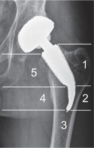 Figure 2. 5 assessment zones around the CUT femoral neck prosthesis (modified according to Gruen).