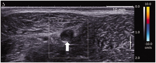 Figure 10. Color Doppler ultrasound image showing the absence of flow in a sheep vein (white arrow) 60 days after treatments.