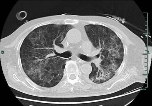 Figure 1 The chest computed tomography scan showed discrete scattered patchy consolidation in both lungs.