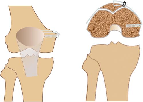 Figure 3 The schedule of MPFL reconstruction with autografts: femoral and patellar bone tunnels.