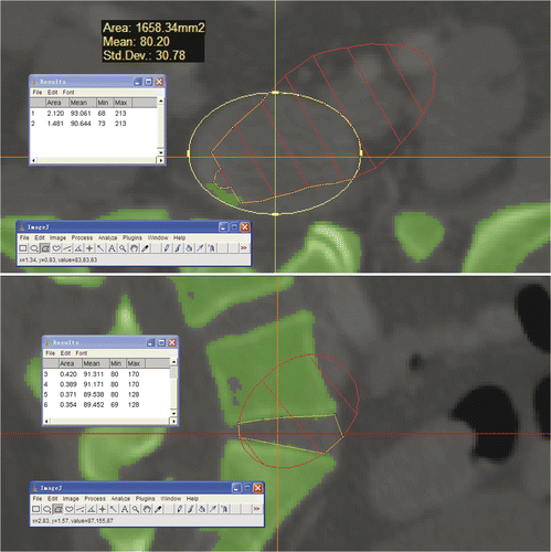 Figure 6. In the axial and sagittal planes that passed through the center of the lumbosacral disc, the area of the discectomy that could be achieved using NPLSIF and the total area of the disc were measured with ImageJ software and the ratio calculated. In this case, the ratio in the axial plane is 1.481/2.120 = 0.699, and the ratio in the sagittal plane is 0.354/0.371 = 0.954.