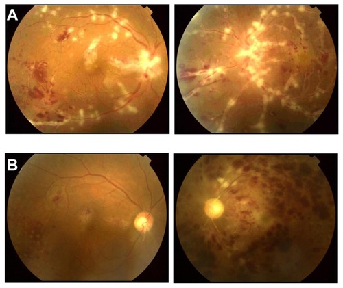 Figure 2 (A) Ophthalmoscopic findings at the time of diagnosis of ARN. Optic disc swelling, macular edema, exudation along blood vessels, narrowing of arterioles, dilatation of venules, and superficial hemorrhages were observed in both retinas. (B) Ophthalmoscopic findings 19 days after retinal photocoagulation. Optic disc swelling, macular edema, and exudation following the course of blood vessels were alleviated in both eyes. Central retinal vein occlusion was observed in the left eye, resulting in neovascular glaucoma.