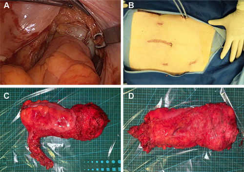 Figure 2 (A) Tension-free anastomosis after low-tie of IMA and preservation of LCA; (B) Completion of laparoscopic surgery for rectal cancer and skin closure of ports; (C-D) Retrieved specimen after low-tie and total mesorectal excision (TME) for rectal cancer.