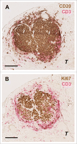 Figure 4. Characterization of T and B cells interaction in germinal centers in the gastric cancer microenvironment. Consecutive slides showing the same B cell zone (A) surrounded by T cells (CD20: brown; CD3: pink). (B) Some of these tumor-associated CD20+ B-cell follicles contained Ki67+ (Ki67: brown) proliferating germinal center B cells. Scale bar indicates 100 µm. T indicates tumor cells.