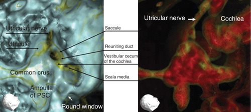 Figure 2. Representative 3DCT images of a right healthy ear. (A) Image obtained using CT window values (CTWVs) of CaCO3 (yellow) and bone (blue). (B) Image obtained using CTWV of CaCO3 (yellow) and water (red). PSC, Posterior semicircular canal.