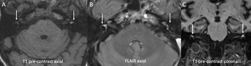 Figure 1 MRI Brain on Initial Presentation. Multiple MRI images reveal bilateral labyrinthine hemorrhages with intrinsic T1 hyperintensity ((A and B) arrows), more prominent on the left, representing blood products. Loss of normal signal suppression is noted throughout the inner ear on FLAIR image (C, arrow).