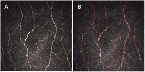 Figure 1. (A) Representative in vivo confocal microscopy image (400 µm × 400 µm) of corneal sub-basal nerve plexus obtained from the central cornea of a patient with blepharoptosis. (B) Fully automated image analysis using ACCMetrics software with main nerve fibres being indicated in red, nerve branches in blue and branch points in green.