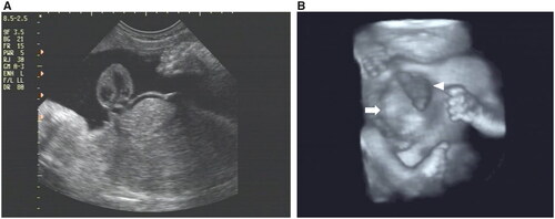 Figure 1. #Case 1. (A) Two-dimensional ultrasound in the sagittal view showing the complete ectopia cordis at 33 weeks of gestation. (B) Three-dimensional ultrasound in the rendering mode showing the ectopia cordis (head arrow) and the omphalocele (arrow) at 34 weeks of gestation.