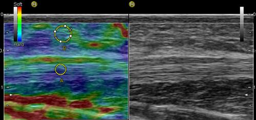 Figure 6 Sonoelastogram (left side of the images) and corresponding B-mode ultrasound images (right side of the images) of the FHL tendon.