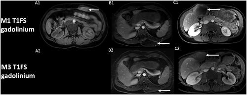 Figure 2. Evolution of contrast uptake after cryotherapy of extra-abdominal desmoid tumors. Post-cryotherapy imaging of three different patients showing at one-month control (A1, B1, C1) the corresponding T1 fat-sat with gadolinium of the core of the phantom of the lesion (arrow), with subsequent decrease in size of the scar lesion at 3-month control (A2, B2, C2). Note that control at 3-month for patient A (A2) was not available at the request of the patient to stop the exam.