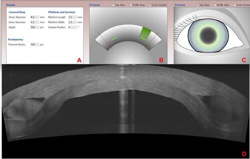 Figure 1 (A–C) Corneal channel dissection parameters programmed into the Alcon/WaveLight FS200 femtosecond laser. (D) Anterior segment OCT illustrates the – as planned – position within the host cornea, of the implanted xenograft intracorneal ring segments.