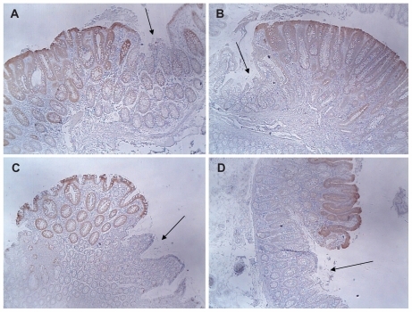 Figure 6 Increased maspin expression in polyps (brown color) compared with minimal expression in adjacent non-neoplastic colonic mucosa (see arrows). (A) Adenomatous polyp; (B) adenomatous polyp; (C) hyperplastic polyp; (D) adenomatous polyp (4× objective).