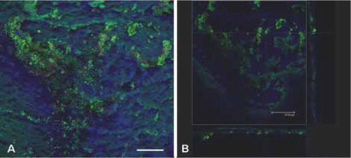Figure 2. CLSM images of biofilm on soft tissue from patient 2. Overlay projection of the biofilm (A) and a projected side-view (B), meaning the biofilm is visualized from the top and from the side (XZ-plane and YZ-plane, respectively). Bar represents 75 µm. CLSM examination showed that the biofilm distribution was patchy (panel A), with some sites containing large clusters of bacteria and other regions showing hardly any evidence of infection. The bacteria were frequently embedded within a self-produced matrix of EPS (panel B). In addition, the infected ulcer was quite superficial, as can be concluded from the biofilm thickness shown in panel B.