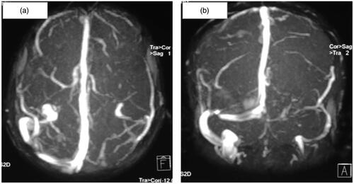 Figure 1. MRI venography of intracerebral vessels showing thrombosis of left transverse and sigmoid sinus in transverse (a) and coronal planes (b).