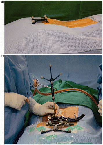 Figure 1. (a) DRF attached to the sacral hiatus with sterile tape. (b) The DRF is positioned out of the way of the surgeon.