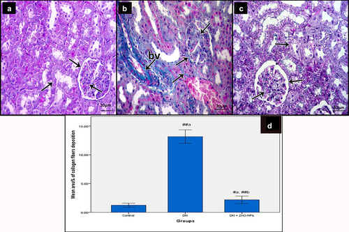 Figure 5. Mallory’s trichrome stained sections of the renal cortex of the study groups. Collagen fibers (arrow) a Control group, showing few collagen fibers. b DN group, showing increased collagen fibers around renal tubules and renal corpuscles, in between glomerular capillaries and within and around the wall of the blood vessels (bv). c DN + ZnO-NPs, showing nearly normal distribution of collagen fibers. d The mean area % of collagen fibers in Mallory’s trichrome-stained sections. Values are displayed as mean ± standard errors (X ± SEM); a: P compared to control group; b: P compared to DN group; #: P< .05; ##: P< .001.