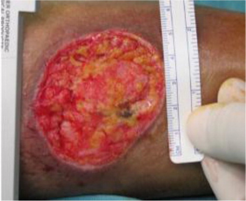 Fig. 1 Wound dimensions measured with ruler.