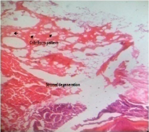 Figure 8. Photomicrograph of prostate tissue section of a rat from group 8 (BPH-induced and treated with 200 mg/kg of EAF) showing diffuse adenomas which appear in a cribriform pattern (black arrows) in the ventral prostrate which are visible and also reduced stroma mainly fibromuscular was equally evident. H&E. mag. 400X.