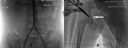 Figure 7 The vascular access (A) and puncture position (B).