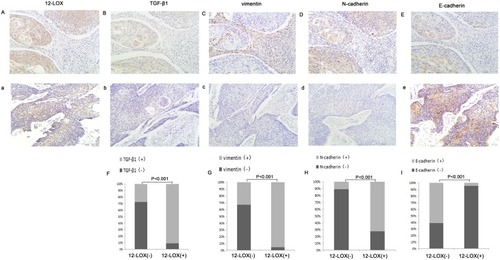 Figure 6 Immunohistochemical staining of 12-LOX in ESCC tissues. The expression of 12-LOX was localized mostly to the cytoplasm of the cells. Figure A and a represented overexpression and low expression of 12-LOX (200 x), respectively. Figure B, b, C, c, D, d, E, e represent the expression of TGF-β1, vimentin, N-cadherin and E-cadherin (200 x). Compared with inferior panel, upper panel represented overexpression of 12-LOX, TGF-β1, vimentin, N-cadherin, and low expression of E-cadherin, which was observed from the tissue from the same patient. F, G, H, I showed the significant correlation between expression of 12-LOX and TGF-β1, vimentin, N-cadherin, E-cadherin (P<0.001).Abbreviation: ESCC, esophageal squamous cell carcinoma.
