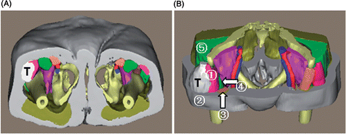 Figure 8. 3D reconstruction of the tumor region for patient 4. (A) Inferior view of the entire 3D model of the tumor region: “T” indicates the tumor. (B) Superior view with some structures cut away to show the spatial relationships between the tumor and peritumoral structures: (1) tensor fasciae latae; (2) subcutaneous fat; (3) sartorius muscle; (4) rectus femoris; (5) gluteus medius. This 3D virtual information can enable surgeons to conceptually understand the tumor characteristics in the tumor region.