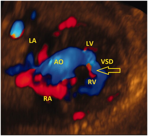 Figure 2. Color Doppler eSTIC off-line analysis: Muscular ventricular septal defect (arrow), off-line color Doppler eSTIC analysis. LA: left atrium; RA: right atrium; LV: left ventricle; RV: right ventricle; VSD: ventricular septal defect.
