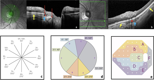 Figure 2 OCT features of a peripapillary intrachoroidal cavitation (PICC) (first raw) and the stepwise procedure of localization of PICC according to Garway-Heath mapping (second raw). (a) Radial section centered on the optic nerve head. Gamma peripapillary atrophy: between the dashed red arrows. (a-b) The yellow arrows highlight the anterior elevations of the posterior choroidal wall at the edge of a posterior protrusion (blue arrow), hallmark of a peripapillary staphyloma. Red star = PICC. It has the two entities essential to its presence: gamma peripapillary atrophy and peripapillary staphyloma. (b) Linear section at the peripapillary zone along the green arrow in the infrared image. (c) Reading of each in every four OCT sections, starting from the 12 o’clock position. (d) Translation to the six peripapillary sectors (a-f) corresponding to the course of the nerve fiber bundles according to Garway-Heath et alCitation21 (e). The corresponding VF sectors. Adapted from Ophthalmology; 107(10), Garway-Heath DF, Poinoosawmy D, Fitzke FW, Hitchings RA. Mapping the visual field to the optic disc in normal tension glaucoma eyes. Ophthalmology. 1809–15, Copyright 2000, with permission from Elsevier.Citation21