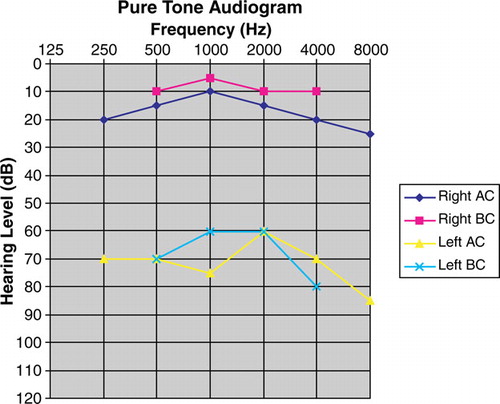 Figure 1.  Pure tone audiogram showed sensorineural deafness of the left ear. Abbreviation: AC: air conduction; BC: bone conduction