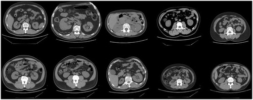 Figure 1. CT images of renal calculi in 10 donor kidneys.