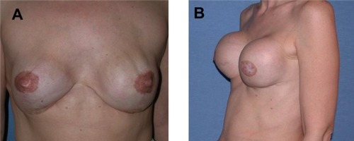 Figure 1 Patient presenting with clinical symptoms indicated by (A) visible rippling and shape changes of the implant and (B) capsular contracture grade 4.