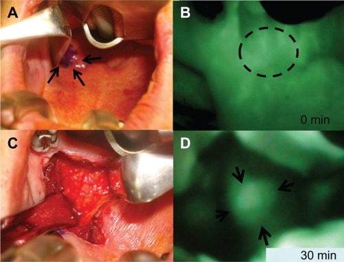 Figure 3 Examination with ICG fluorescence image for recurrent retropharyngeal node from hypopharyngeal carcinoma intraoperative findings between 0 minutes and 30 minutes after ICG injection. (A) Intrapharyngeal finding. Retropharyngeal tumor was not palpable and not visible. Tumor location marked based on ICG image (arrows). (B) ICG fluorescence image soon after ICG injection. ICG fluorescence visualizes diffusely recurrent retropharyngeal node on posterolateral oropharynx soon after ICG injection (dotted circle). (C) Pharyngeal mucosa incision. Left soft palate is incised. The tumor, covered with fasciae, cannot be observed on the white LED light 30 minutes after ICG injection. (D) ICG image at 30 minutes after ICG injection.