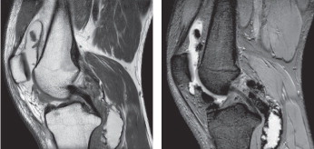 Figure 3. MRI of diffuse-type TGCT: a 23-year-old male patient with an extensive proliferative synovial process around both cruciate ligaments, dominating the anterior and posterior knee compartments, intra- and extra-articular. Inside suprapatellar pouch and Baker’s cyst a blooming villonodular aspect shows typical iron depositions. Left panel: Sagittal proton density weighted turbo spin echo MRI. Right panel: Sagittal T2-weighted fast field echo MRI.